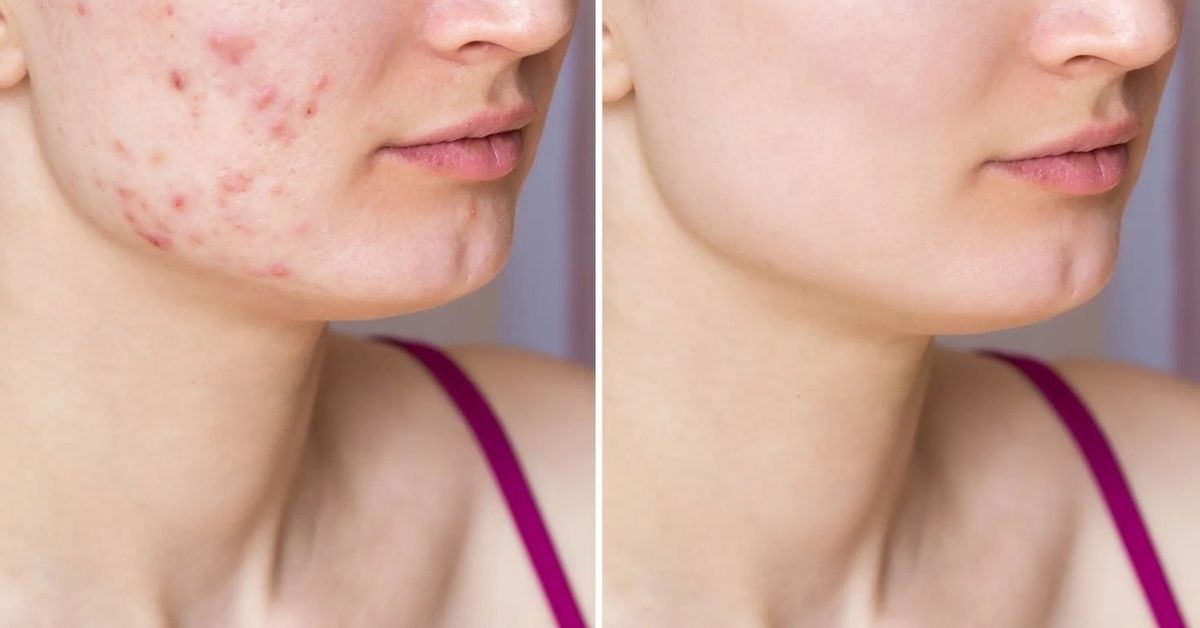 Acne solutions