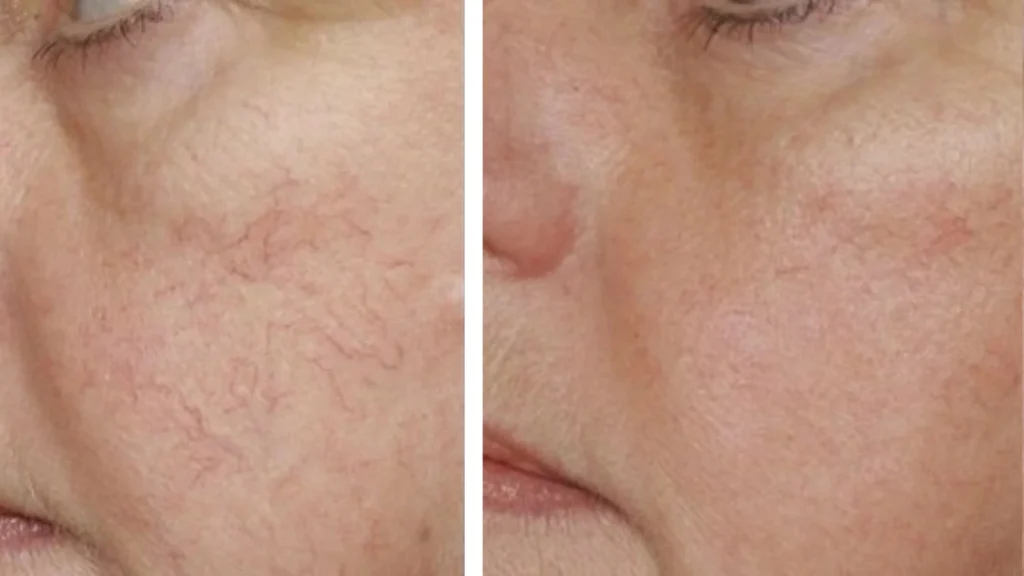 Side profile before and after botox injection Toronto treatment showing smoother skin and reduced facial lines