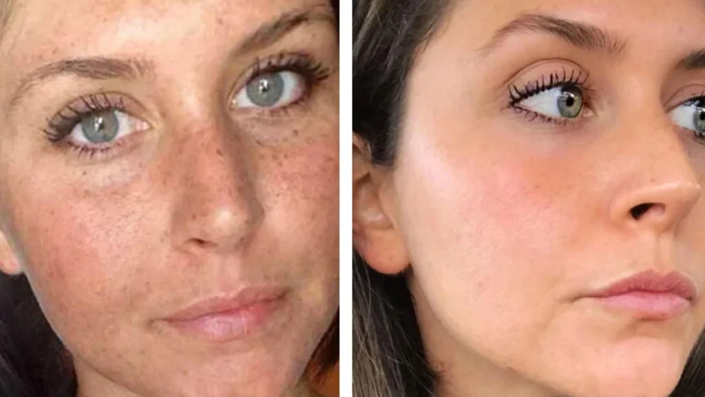 Botox Injection Toronto – Before and After Facial Rejuvenation Results