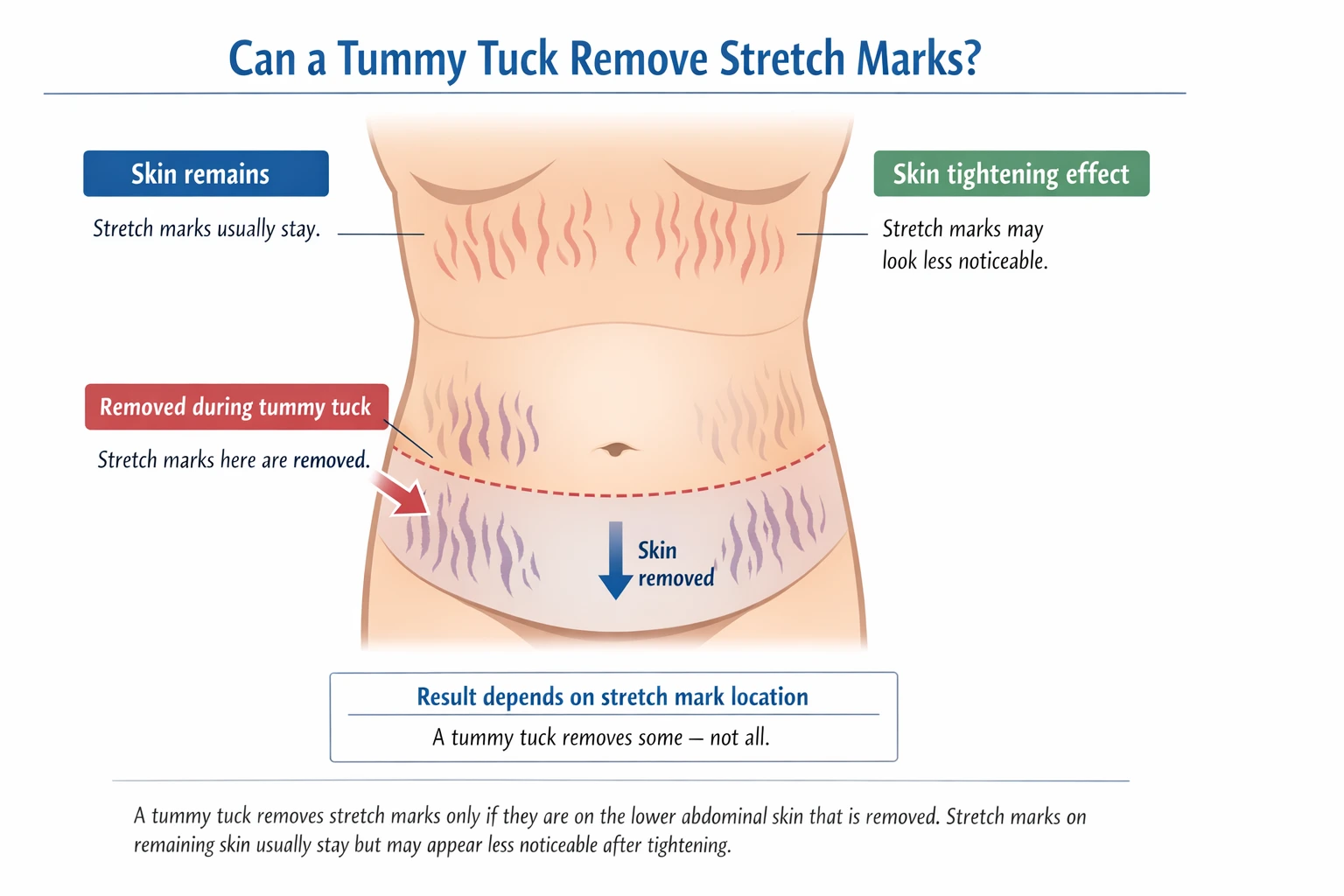 Illustration explaining whether a tummy tuck removes stretch marks, showing lower abdominal skin removal, remaining stretch marks, and skin tightening effects after abdominoplasty