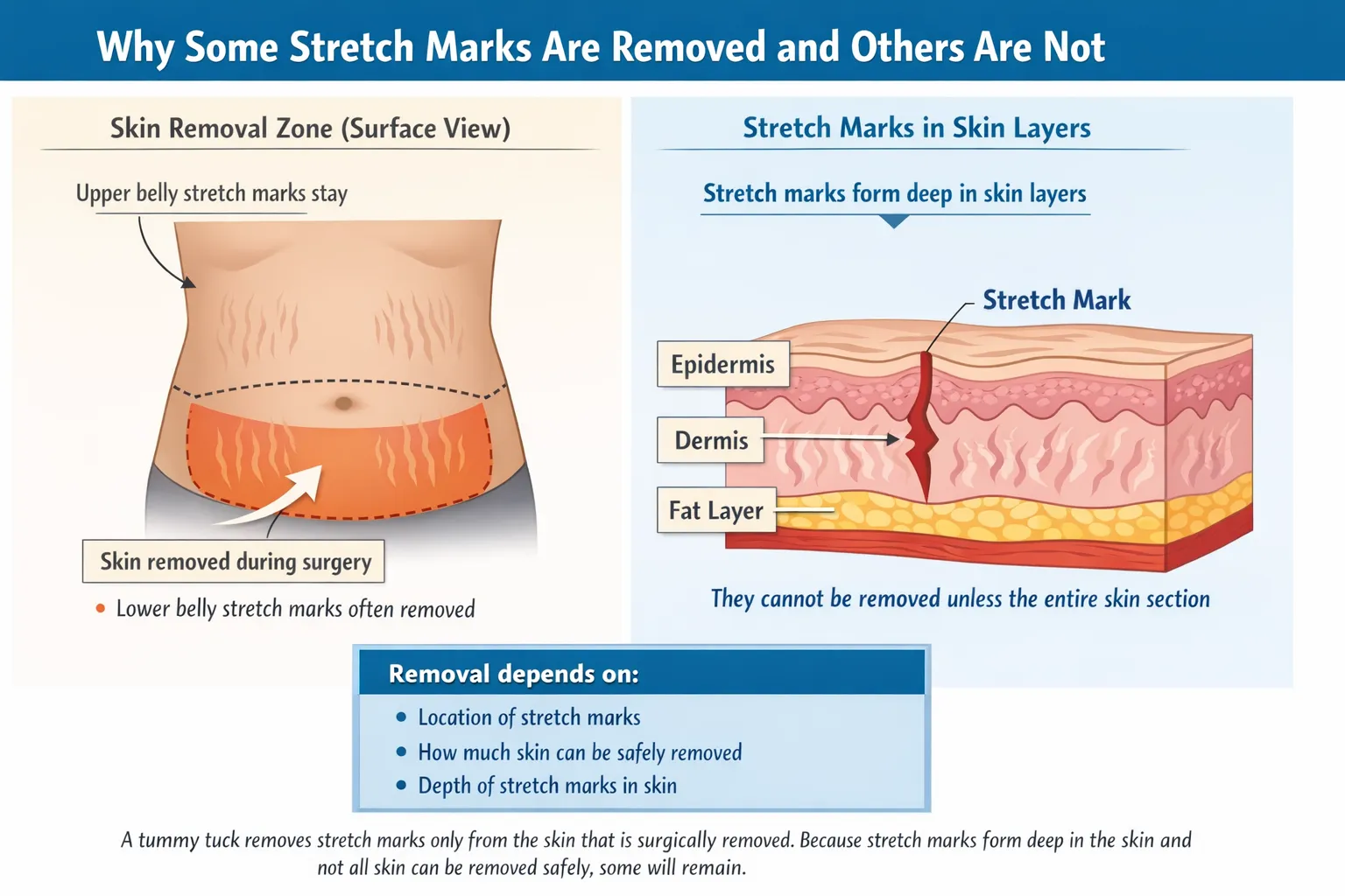 Medical illustration showing why some stretch marks are removed during a tummy tuck, highlighting lower abdominal skin removal zone and stretch marks forming deep in skin layers