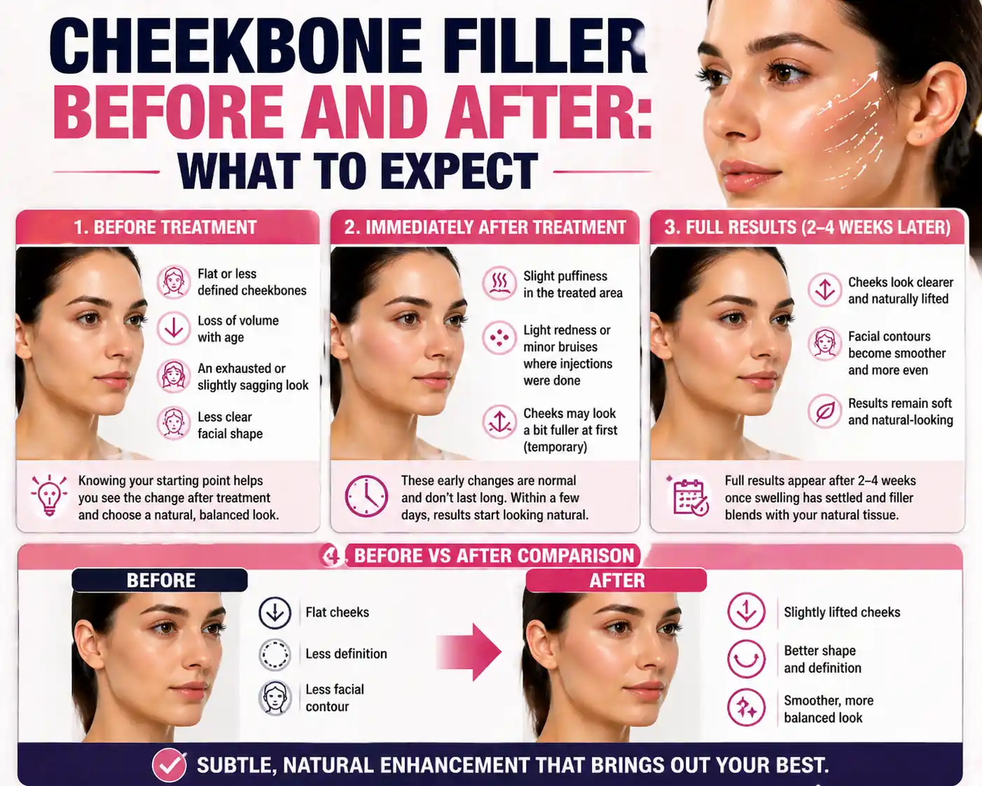 Infographic showing cheekbone filler stages: before, immediate post-treatment swelling, and full results after 2-4 weeks.
