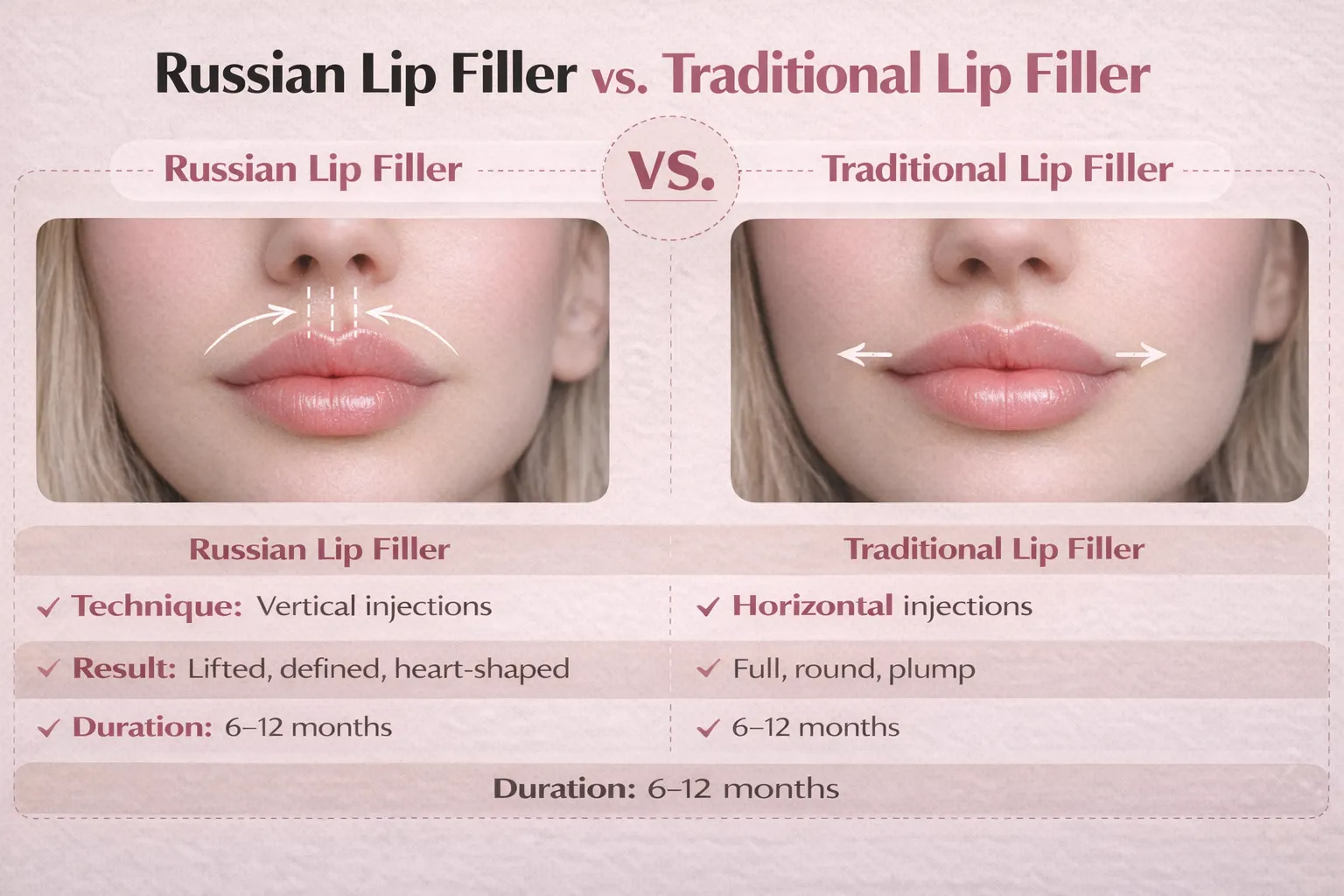 Infographic comparing Russian lip fillers and traditional lip fillers, highlighting the differences in technique, results, and duration. Russian fillers use vertical injections for a heart-shaped, lifted look, while traditional fillers use horizontal injections for fuller, plumper lips, both lasting 6–12 months.